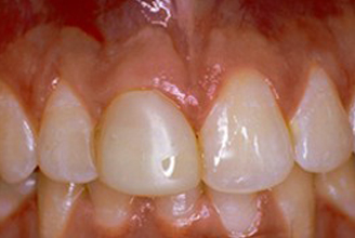 Front (left) Central tooth has a poor restoration. Does not look natural and is not contoured properly to match the gumline of the rest of the teeth.