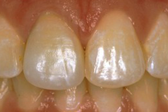 Replaced with an All Porcelain Crown (no metal). Tooth is now contoured to match the rest of the gumline. Restored tooth looks very natural and matches the shape and color of the patient's teeth.
