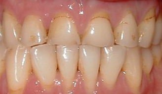 Patient needs Upper Arch Rehabilitation. Presents with Upper Anterior teeth that are stained, incisal edges (tooth edge) are worn down and chipped, and gumline recession is present.