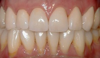 Smile restored with placement of 8 Upper All Porcelain Crowns (Caps). Gumline and incisal edges are now uniform. Patient now has longer, better shaped teeth to enhance the smile line and aid in chewing/biting function.