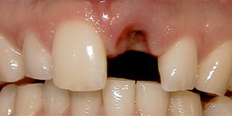 Patient needs a Single Tooth Replacement of one Upper Central Incisor.