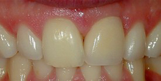 Smile and function restored with a Single Implant and an All Porcelain Crown (Cap) that fits securely over the implant.