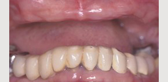 Patient needs Upper and Lower Arch Rehabilitation.