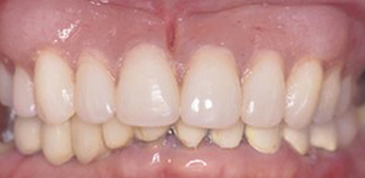 Great smile, chewing function, and facial tissue support possible with an Upper Denture that is supported with Implants and Lower Implants and Crowns.