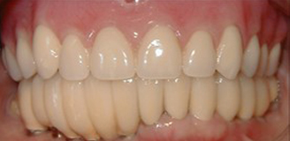 Patient needs Upper and Lower Arch Rehabilitation.