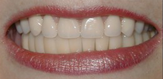 Great smile, chewing function, and facial tissue support possible with an Upper Denture that is supported with Implants and Lower Implants and Crowns.