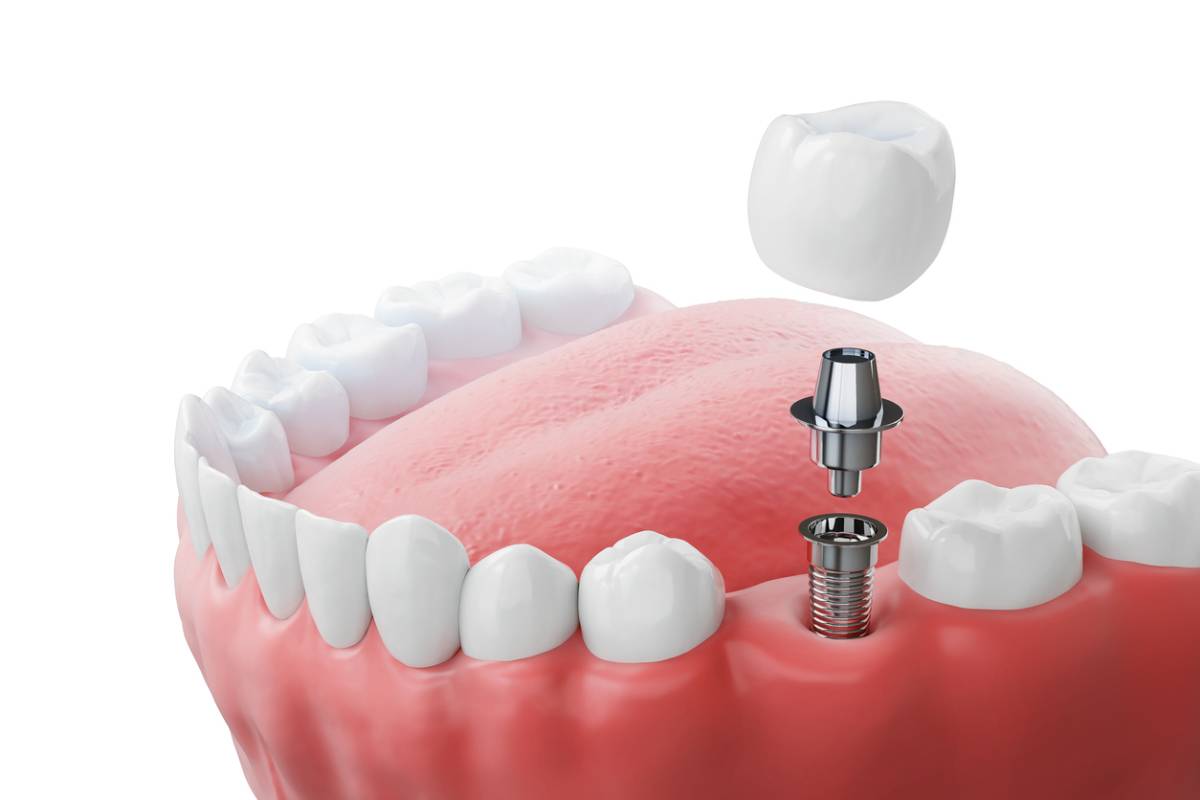 Featured image for How Long Do Dental Implants Last?