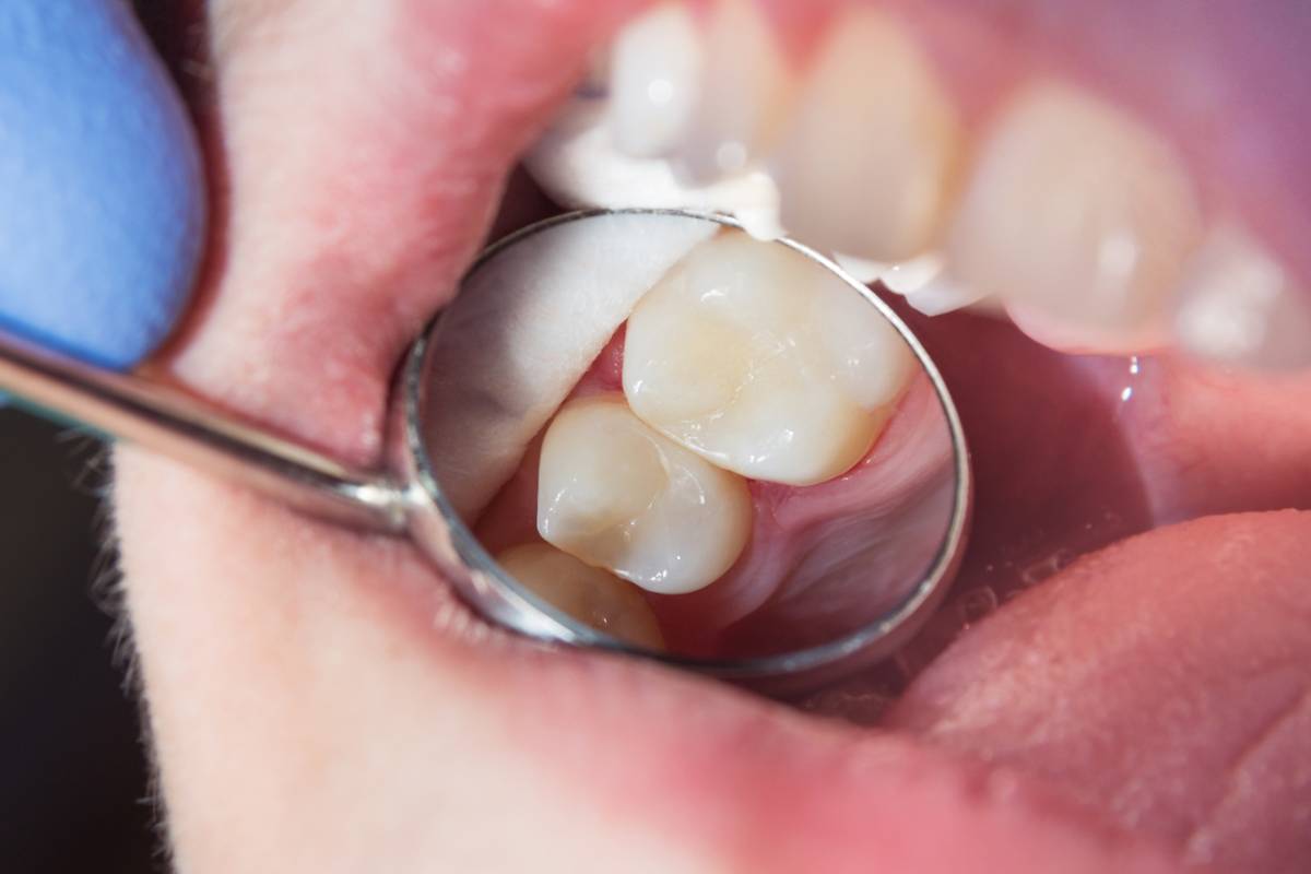 Featured image for What Are the Pros and Cons of Composite Fillings?