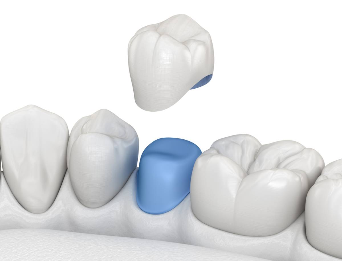 featured image for is it common for dental crowns to fall off